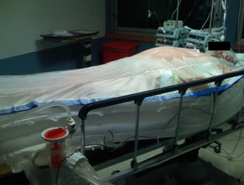 High BMI patient with ThermoSuit